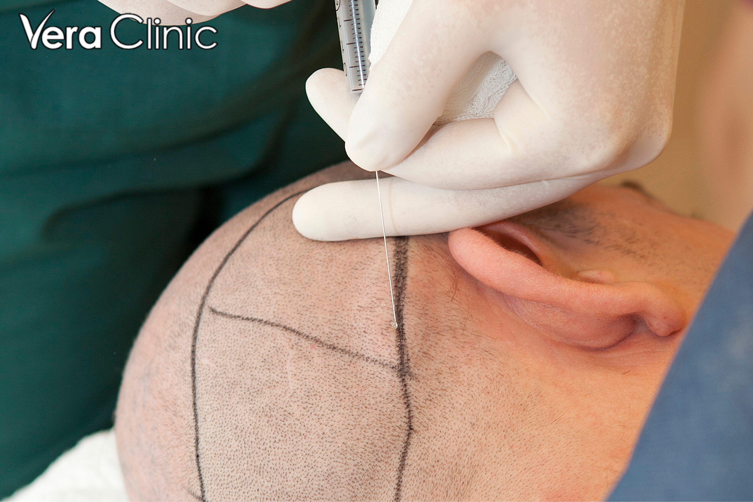 best hair transplant turkey