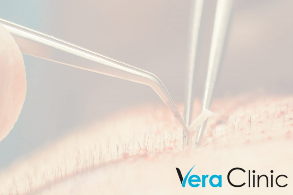 The Truth About Hair Transplants In Turkey: Cost, Benefits, and Risks